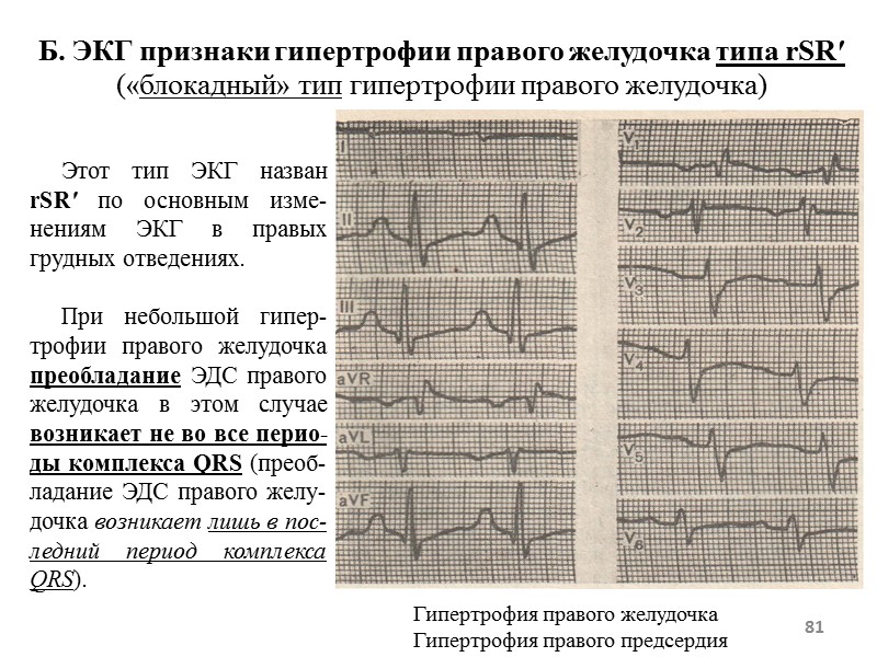 81 Б. ЭКГ признаки гипертрофии правого желудочка типа rSR′ («блокадный» тип гипертрофии правого желудочка) 81 Б. ЭКГ признаки гипертрофии правого желудочка типа rSR′ («блокадный» тип гипертрофии правого желудочка)